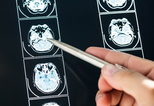 Four levels of psychotherapy after brain injury
